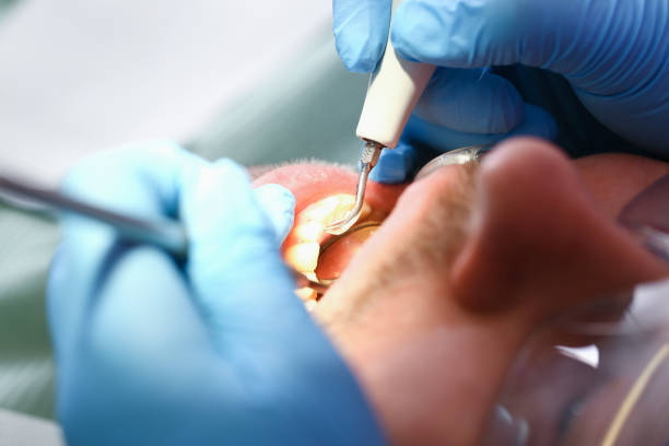 Best Emergency Tooth Extraction in Quitman, GA