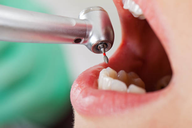 Best Emergency Treatment for Dental Infections or Abscesses in Quitman, GA